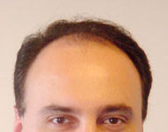 področna plešavost